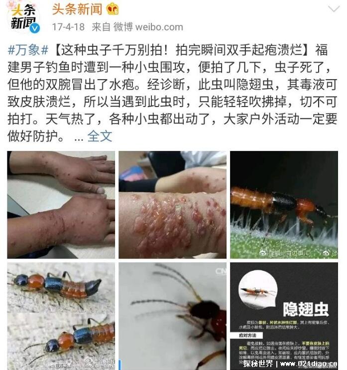 隐翅虫咬人后图片治疗方法隐翅虫留下的疤是永久的吗