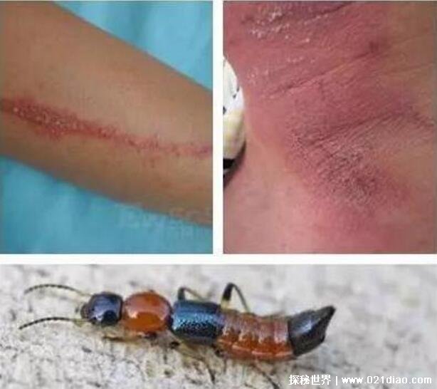隐翅虫咬人后图片治疗方法隐翅虫留下的疤是永久的吗