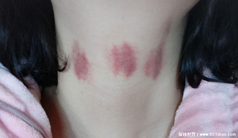 快速消除吻痕的办法