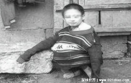 中国狼孩小杰怎么样了，现已获得了治疗情况正在好转
